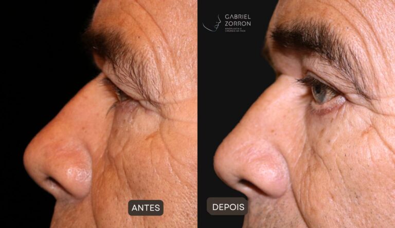Antes e depois de blefaroplastia em homem.