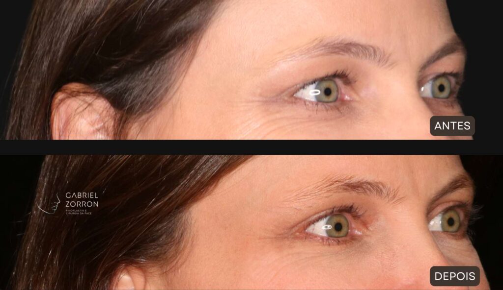 Antes e depois de blefaroplastia em mulher.