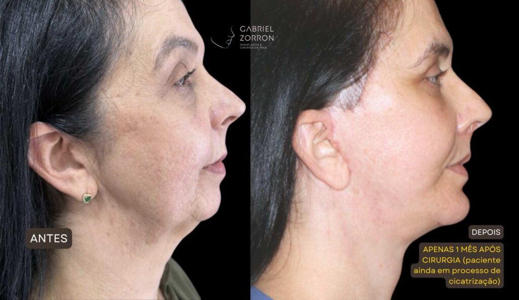 foto de antes e depois de lifting facial deep plane com dr gabriel zorron