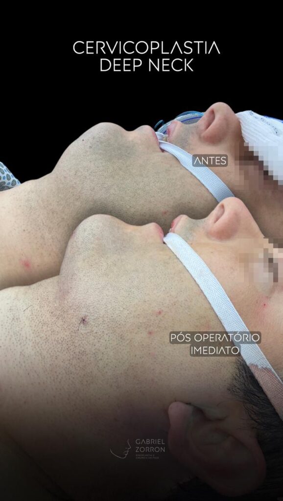 foto antes e depois de cervicoplastia