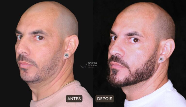 foto antes e depois de perfiloplastia masculina realizada pelo cirurgião Dr. Gabriel Zorron, especialista em plástica da face: rinoplastia, mentoplastia, cervicoplastia.
