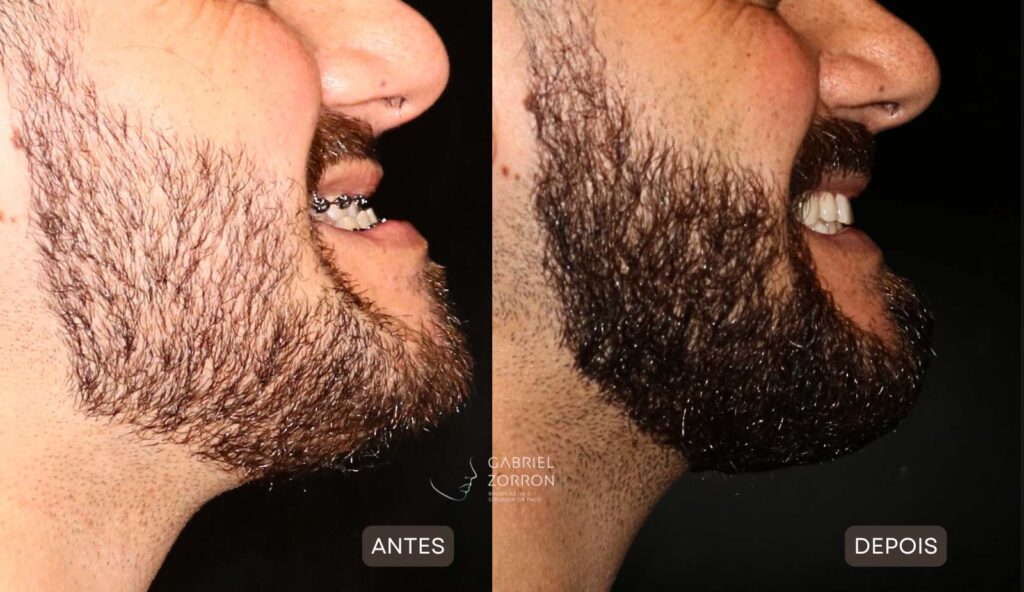 foto antes e depois cirurgia ortognática classe 3 para queixo projetado feita pelo cirurgião especialista gabriel zorron