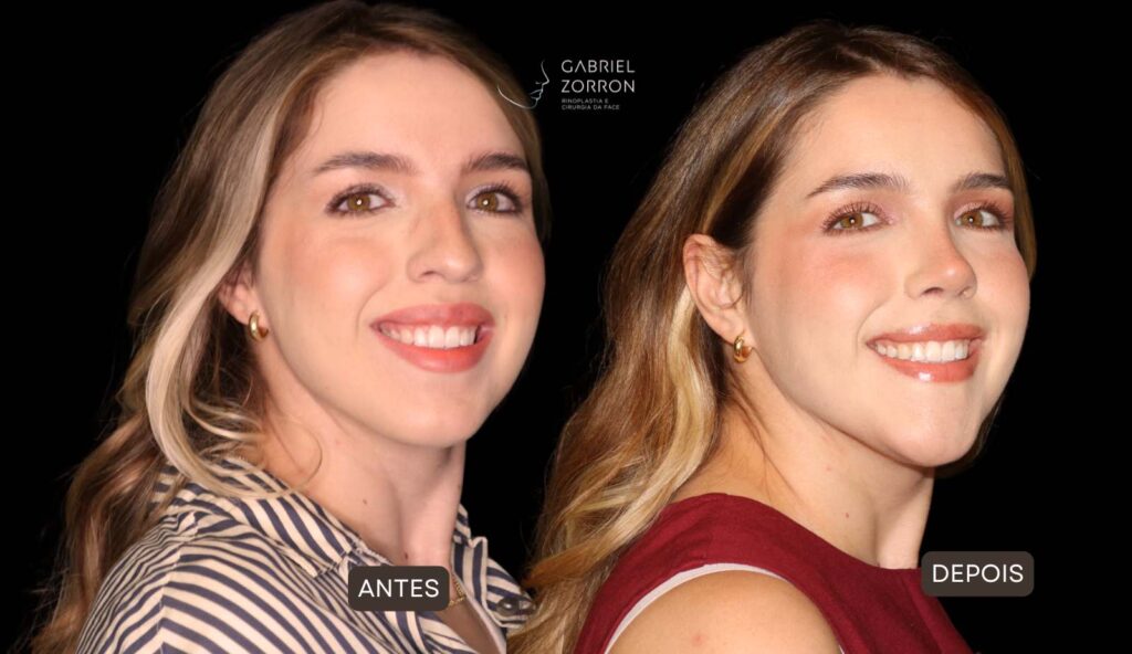 foto de antes e depois de cirurgia de mentoplastia em mulher executada pelo cirurgião cranio maxilo facial referência em plástica da face Gabriel Zorron
