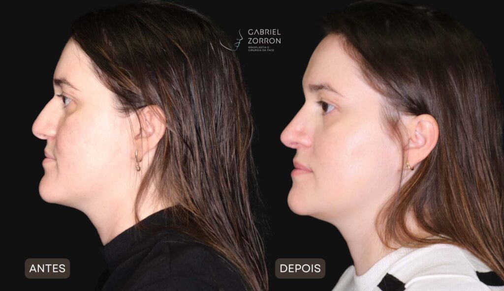 Foto de antes e depois de rinoplastia natural com um dos melhores otorrinos cirurgiões do Brasil, Gabriel Zorron