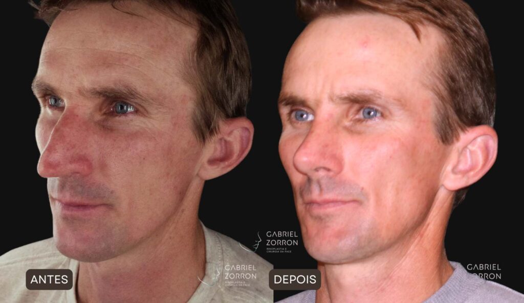 Foto de antes e depois de rinoplastia em homem com um dos melhores otorrinos cirurgiões do Brasil, Gabriel Zorron