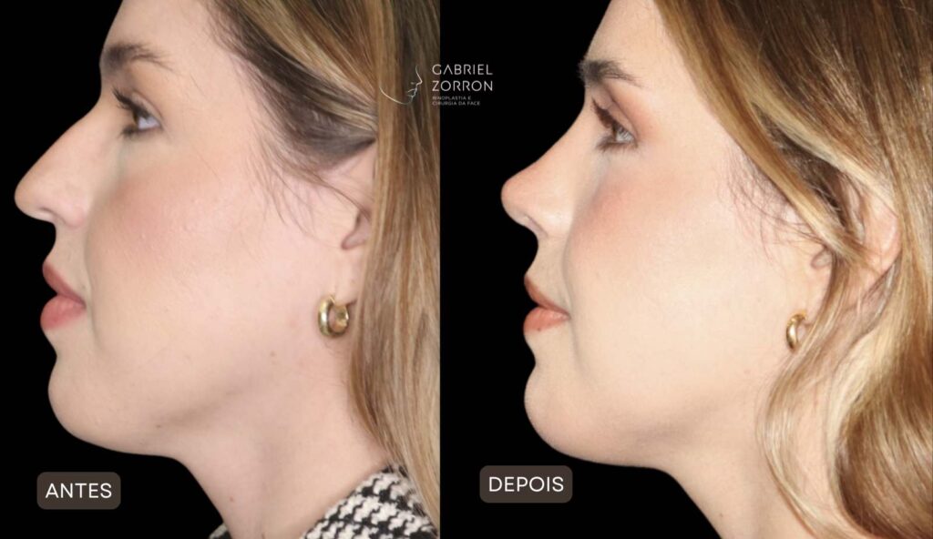 Foto de antes e depois de rinoplastia feminina com um dos melhores otorrinos cirurgiões do Brasil, Gabriel Zorron