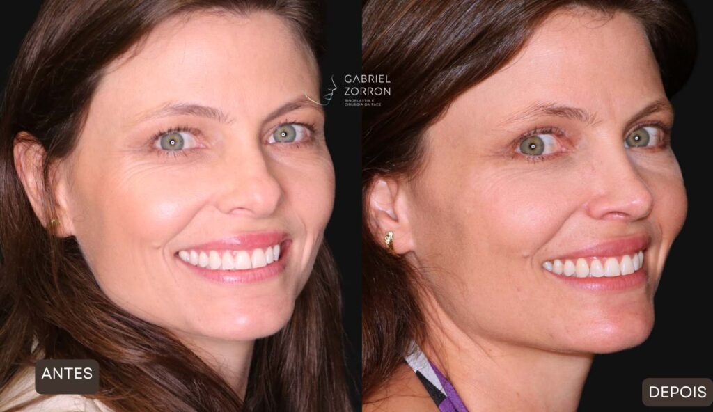 Foto de antes e depois de rinoplastia com um dos melhores otorrinos cirurgiões do Brasil, Gabriel Zorron