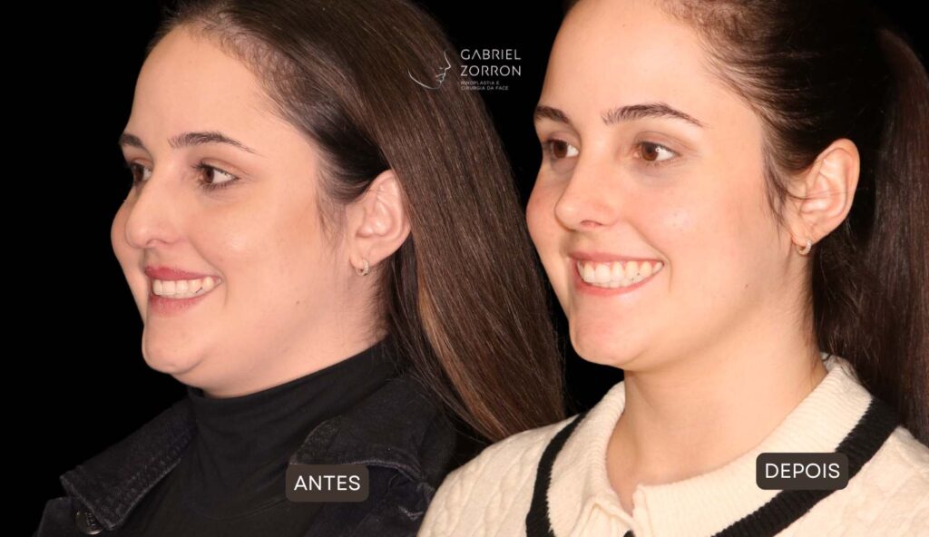 Foto de antes e depois de rinoplastia natural com um dos melhores otorrinos cirurgiões do Brasil, Gabriel Zorron