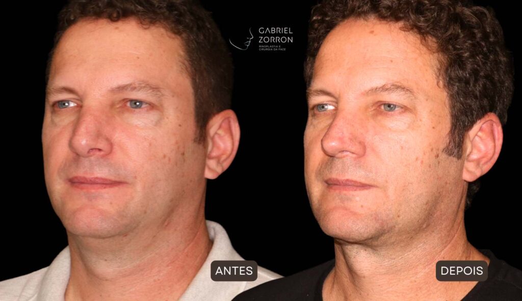 Foto de antes e depois de rinoplastia natural em homem com um dos melhores otorrinos cirurgiões do Brasil, Gabriel Zorron