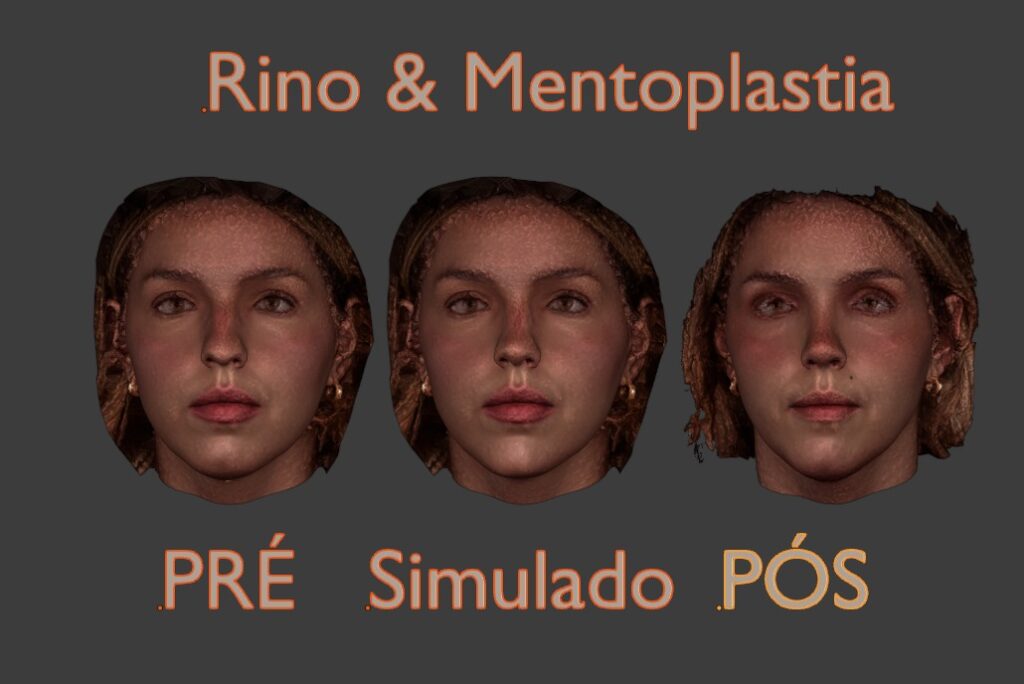 foto de simulação em 3D de antes e depois de cirurgia de mentoplastia em mulher executada pelo cirurgião cranio maxilo facial referência em plástica da face Gabriel Zorron