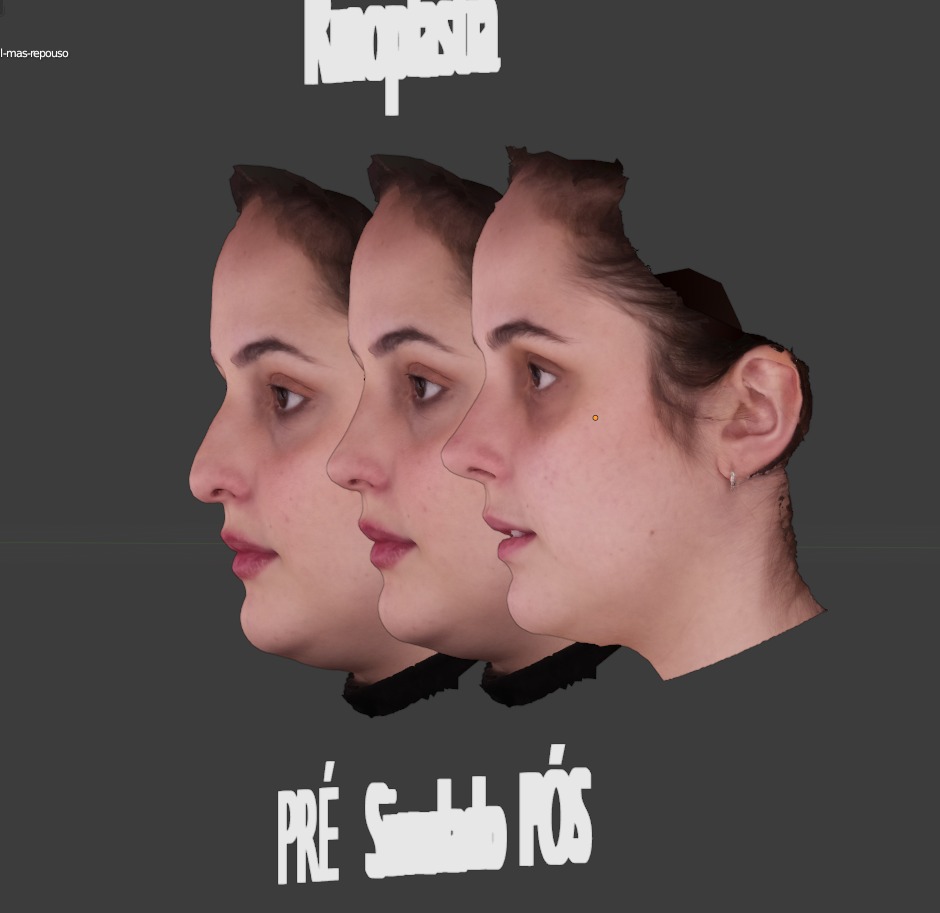 foto de simulação em 3D de antes e depois de cirurgia de rinoplastia em mulher executada pelo cirurgião cranio maxilo facial referência em plástica da face Gabriel Zorron