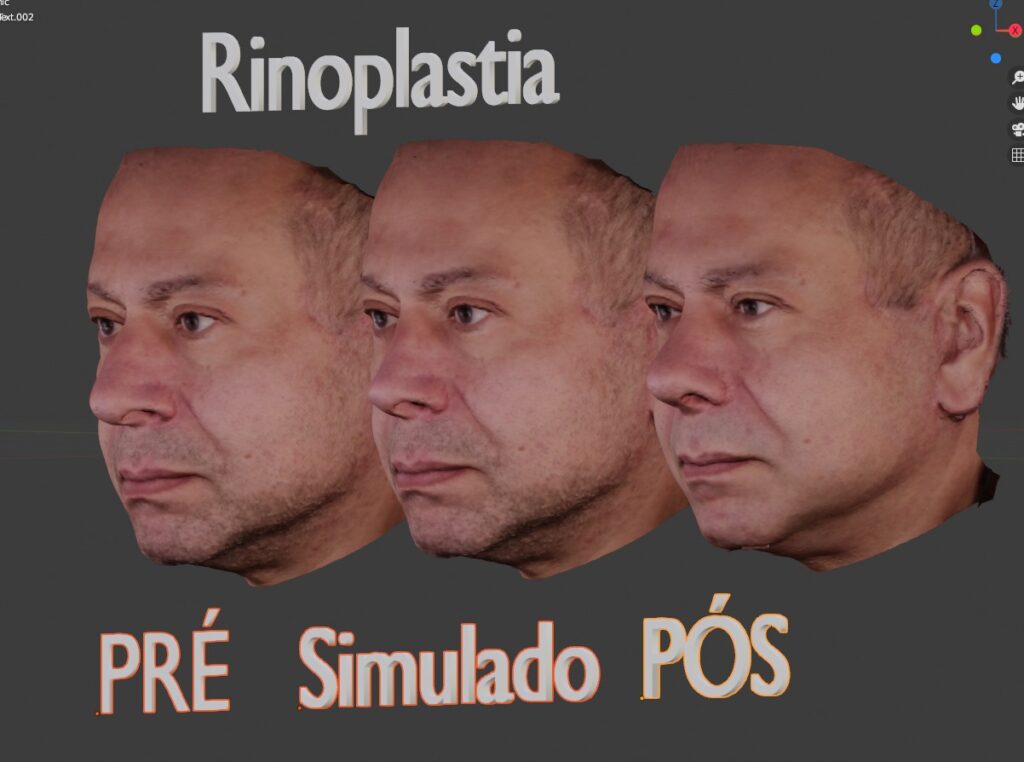 foto de simulação em 3D de antes e depois de cirurgia de rinoplastia em homem executada pelo cirurgião cranio maxilo facial referência em plástica da face Gabriel Zorron