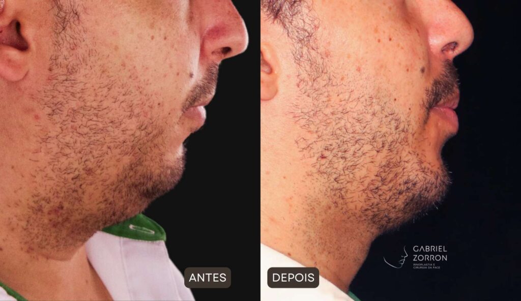 antes e depois de cirurgia ortognática realizada pelo especiaista em cirurgia de face Dr Gabriel Zorron.