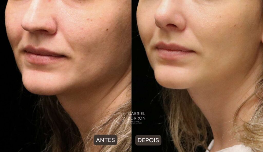 antes e depois de rinoplastia realizada pelo otorrino e cirurgião especialista em face Dr Gabriel Zorron.