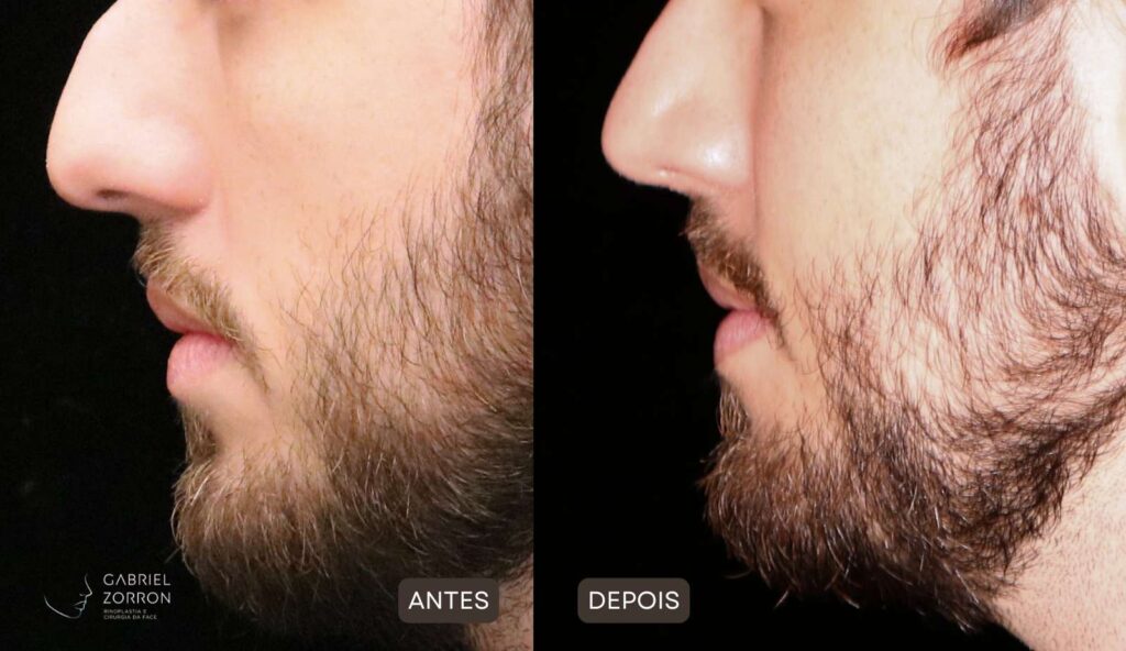 antes e depois de rinoplastia realizada pelo otorrino e cirurgião especialista em face Dr Gabriel Zorron.