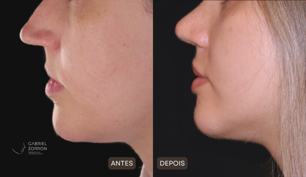 cirurgia rinoplastia antes e depois gabriel zorron