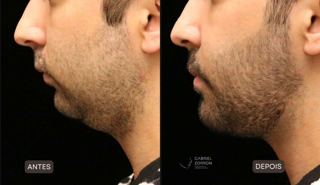 antes e depois de cirurgia ortognatica realizada pelo otorrino e cirurgião especialista em face Dr Gabriel Zorron.