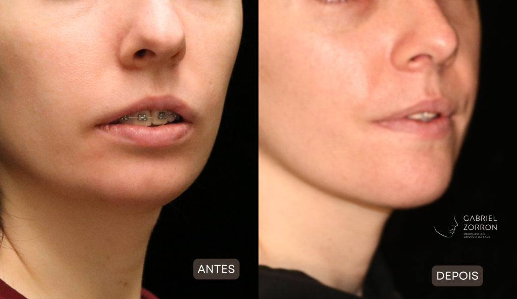 cirurgia ortognatica antes e depois gabriel zorron