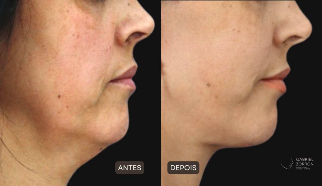 antes e depois lifting facial