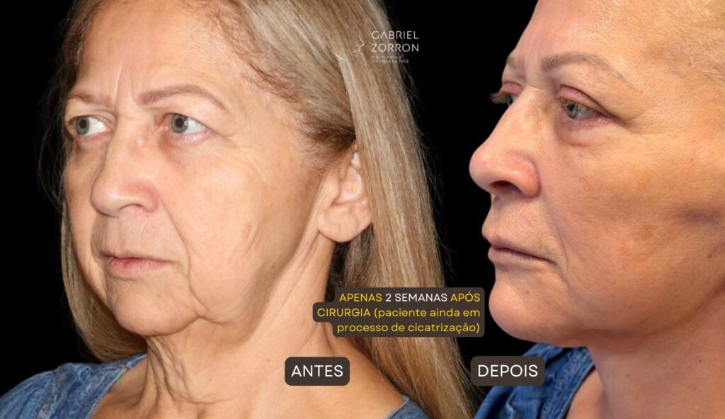foto de paciente se recuperando da cirurgia de lifting facial com dr gabriel zorron, após 15 dias da operação