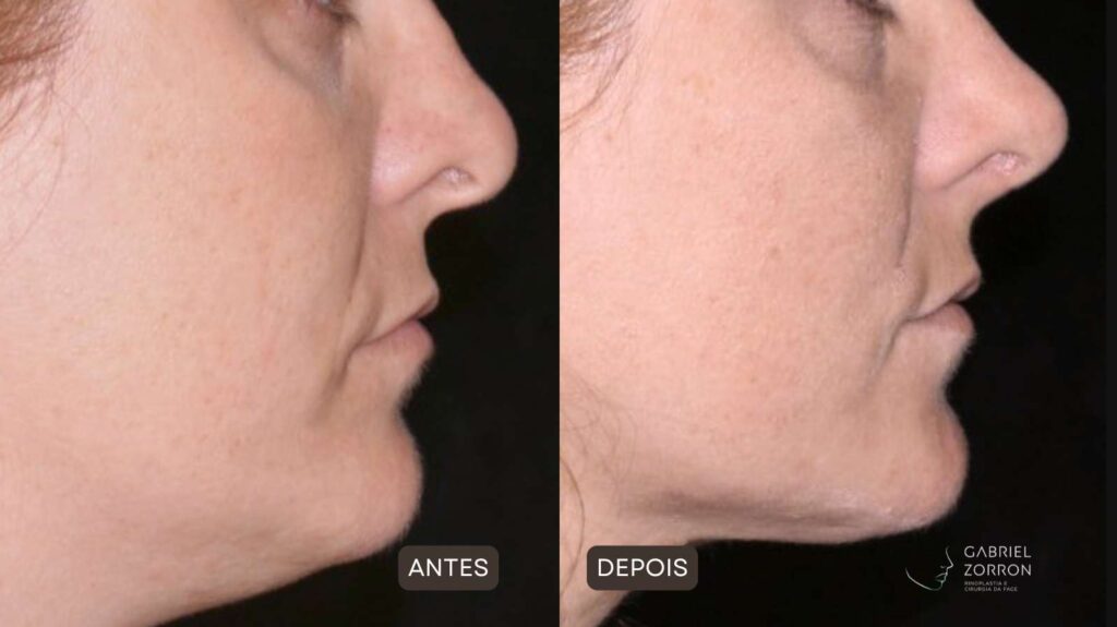 antes e depois rinoplastia dr gabriel zorron