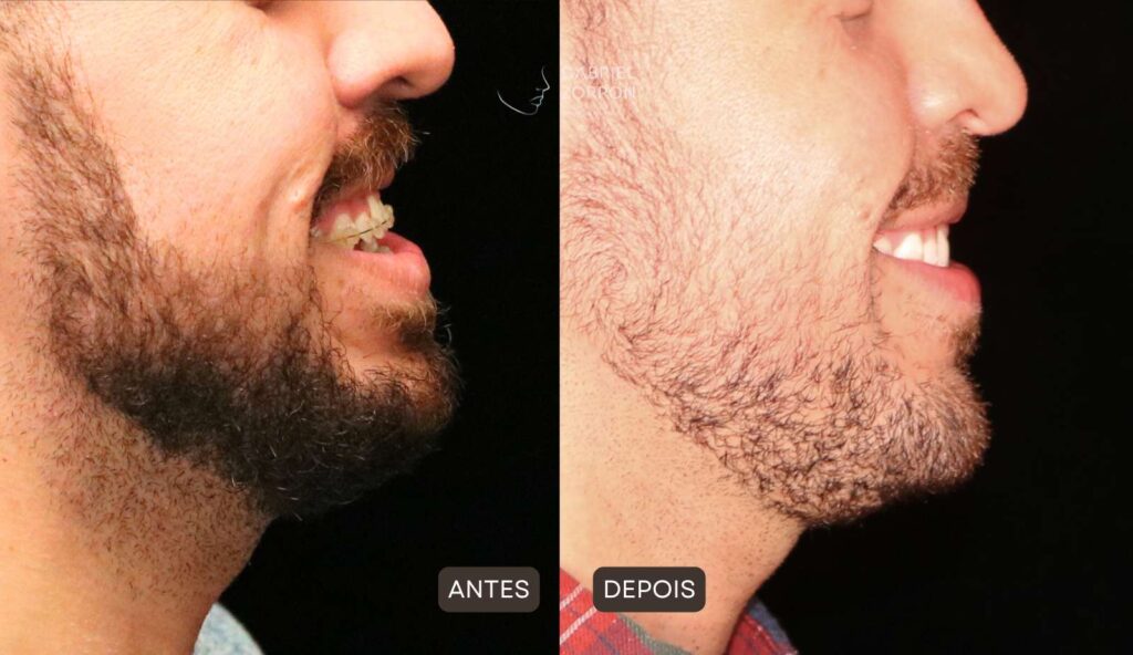 Foto antes e depois ortognática com Dr Gabriel Zorron especialista em cirurgia facial