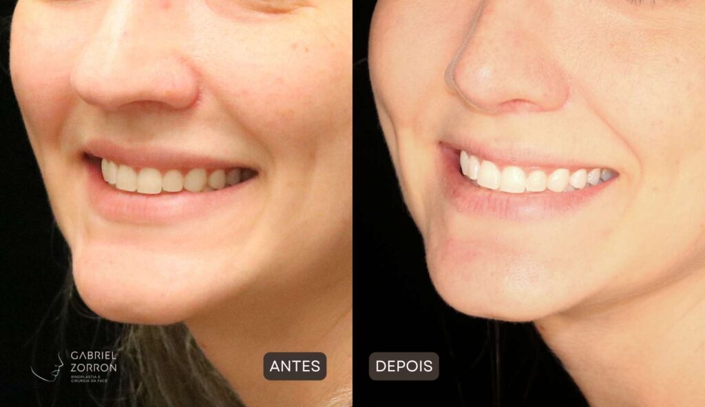 Foto antes e depois rinoplastia com Dr Gabriel Zorron especialista em cirurgia facial