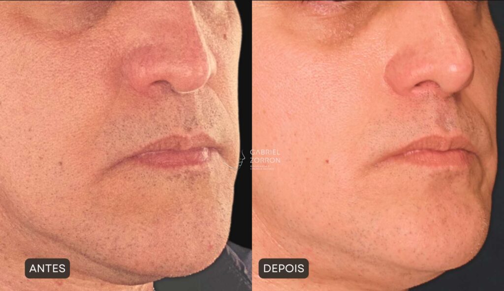 Foto antes e depois rinoplastia com Dr Gabriel Zorron especialista em cirurgia facial