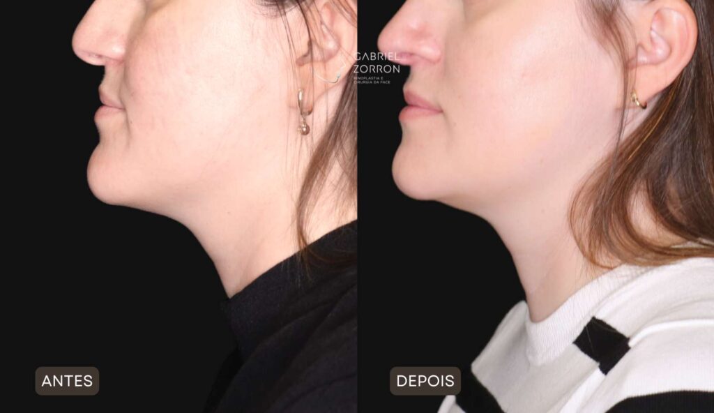 Foto antes e depois rinoplastia e mentoplastia (perfiloplastia) com Dr Gabriel Zorron especialista em cirurgia facial