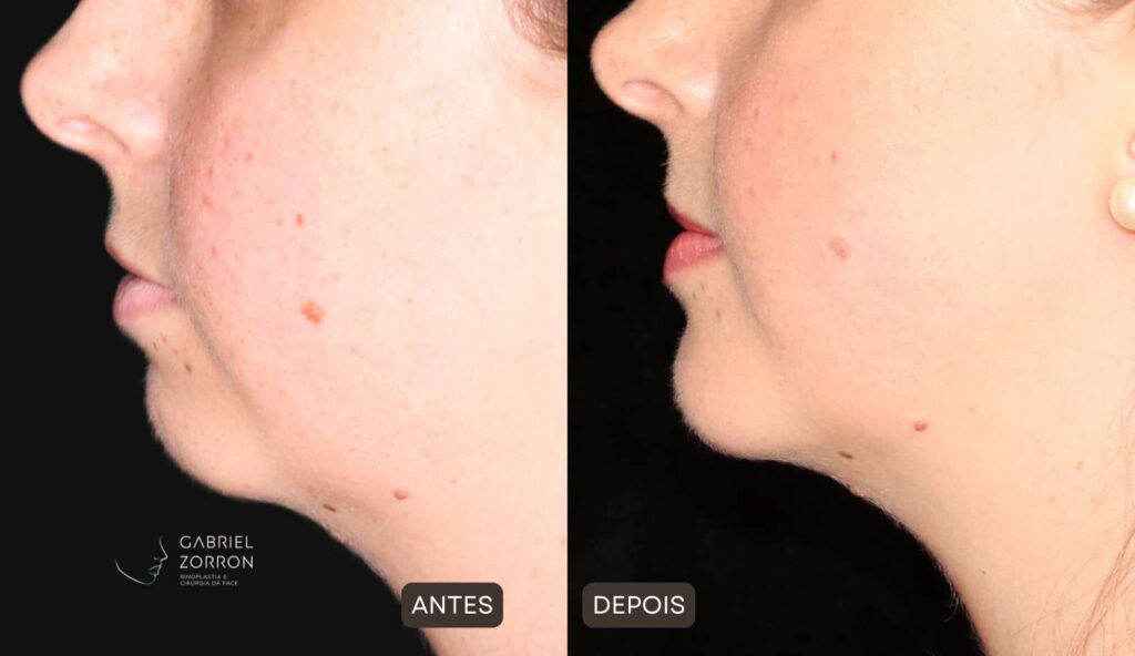 Foto antes e depois ortognática com Dr Gabriel Zorron especialista em cirurgia facial