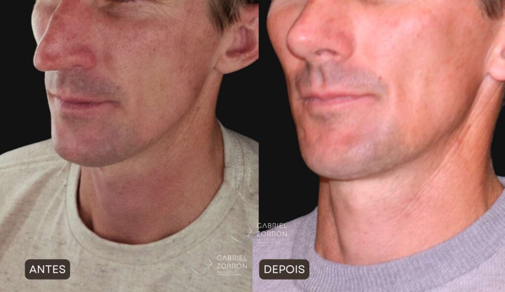 Foto antes e depois rinoplastia com Dr Gabriel Zorron especialista em cirurgia facial