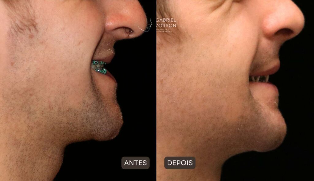 Foto antes e depois ortognática com Dr Gabriel Zorron especialista em cirurgia facial