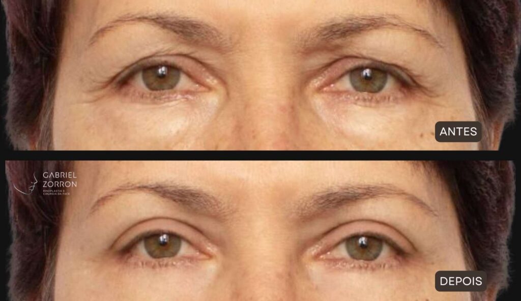 Foto antes e depois blefaroplastia com Dr Gabriel Zorron especialista em cirurgia facial