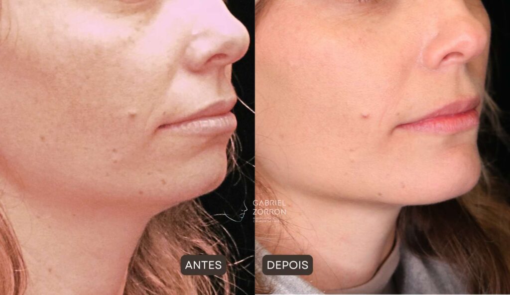 Foto antes e depois mentoplastia com Dr Gabriel Zorron especialista em cirurgia facial