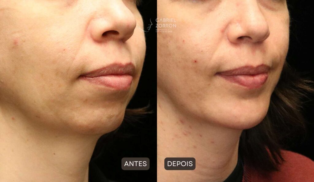 Foto antes e depois mentoplastia com Dr Gabriel Zorron especialista em cirurgia facial
