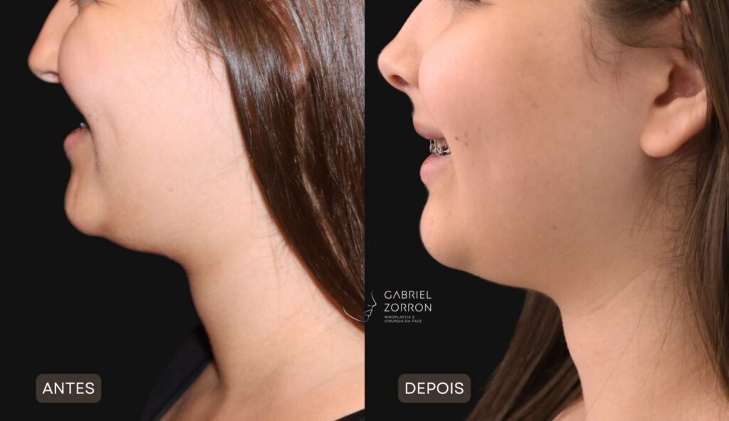 Foto antes e depois ortognática com Dr Gabriel Zorron especialista em cirurgia facial