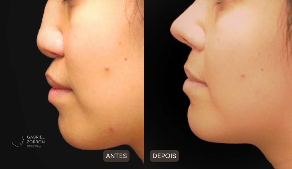 Foto antes e depois rinoplastia com Dr Gabriel Zorron especialista em cirurgia facial