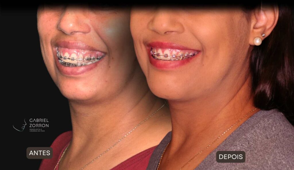 Cirurgia ortognática com especialista referência no Brasil otorrino e cirurgião crânio-maxilo-facial Dr Gabriel Zorron