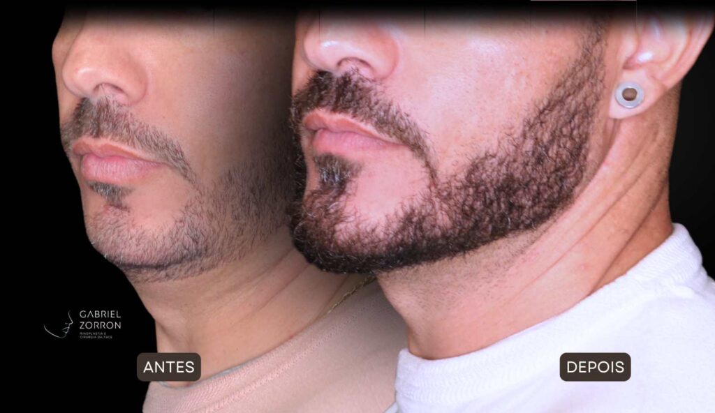 Cirurgia ortognática com especialista referência no Brasil otorrino e cirurgião crânio-maxilo-facial Dr Gabriel Zorron