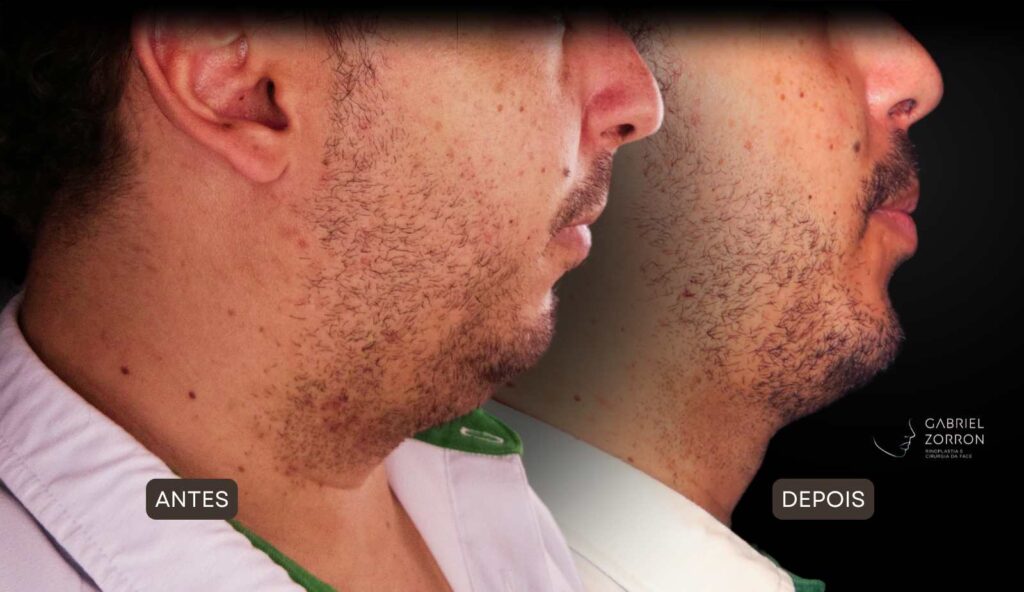 Cirurgia ortognática com especialista referência no Brasil otorrino e cirurgião crânio-maxilo-facial Dr Gabriel Zorron