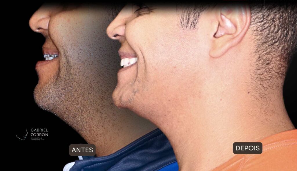 Cirurgia ortognática com especialista referência no Brasil otorrino e cirurgião crânio-maxilo-facial Dr Gabriel Zorron