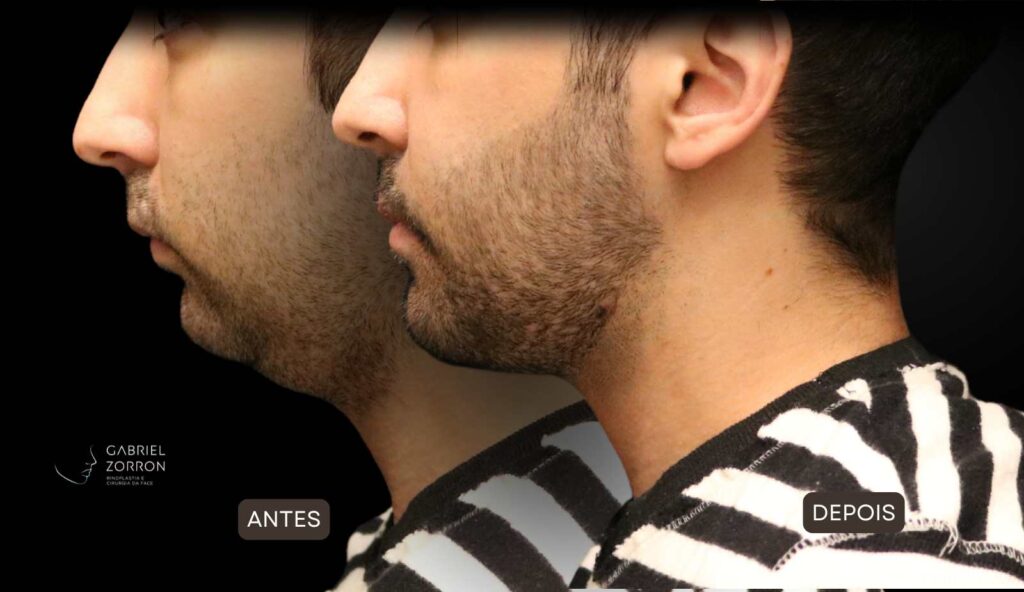 Cirurgia ortognática com especialista referência no Brasil otorrino e cirurgião crânio-maxilo-facial Dr Gabriel Zorron