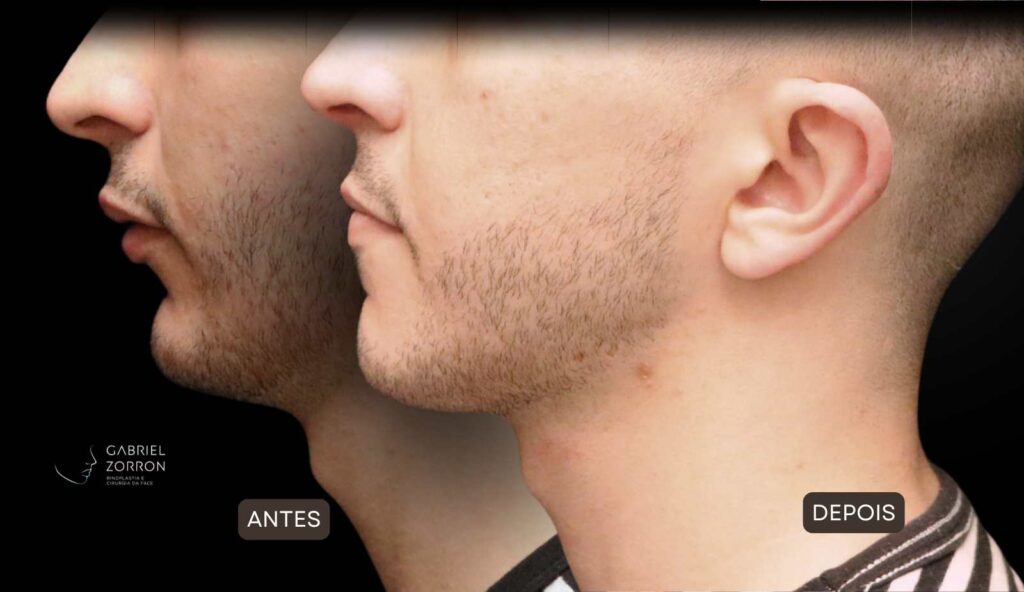 Cirurgia ortognática com especialista referência no Brasil otorrino e cirurgião crânio-maxilo-facial Dr Gabriel Zorron