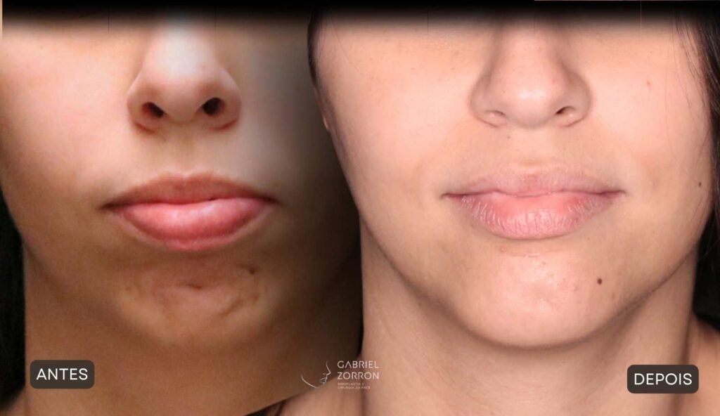 Cirurgia ortognática com especialista referência no Brasil otorrino e cirurgião crânio-maxilo-facial Dr Gabriel Zorron