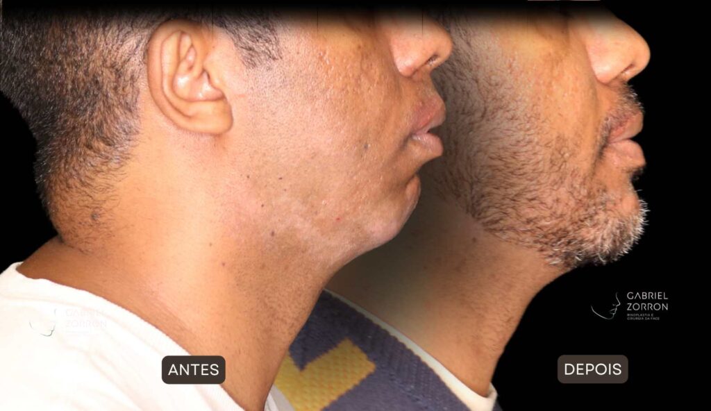 Cirurgia ortognática com especialista referência no Brasil otorrino e cirurgião crânio-maxilo-facial Dr Gabriel Zorron