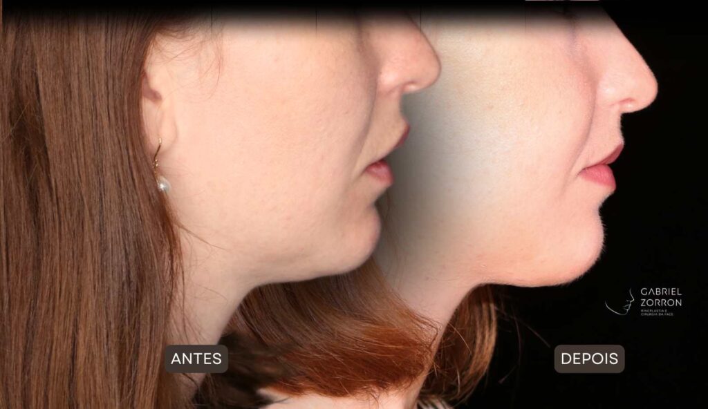 Cirurgia ortognática com especialista referência no Brasil otorrino e cirurgião crânio-maxilo-facial Dr Gabriel Zorron