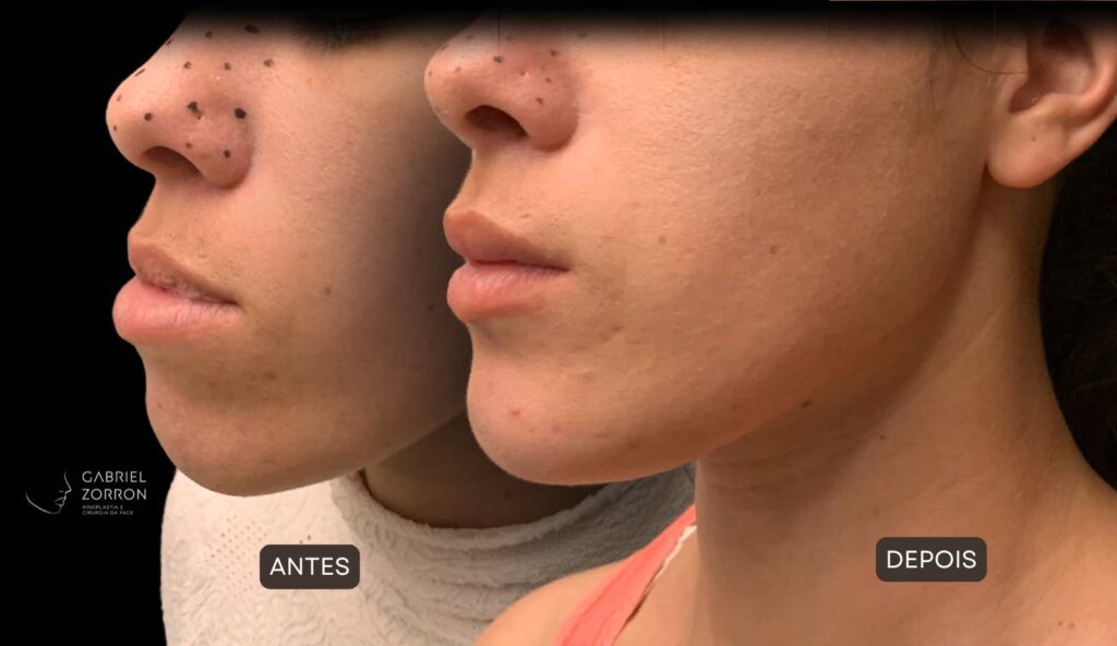 Cirurgia ortognática com especialista referência no Brasil otorrino e cirurgião crânio-maxilo-facial Dr Gabriel Zorron