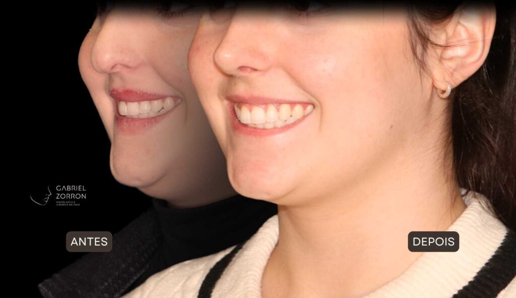 Foto de antes e depois de rinoplastia feminina e natural, realizada pelo especialista Dr Gabriel Zorron - otorrino e cirurgião crânio-maxilo-facial e plástica da face.