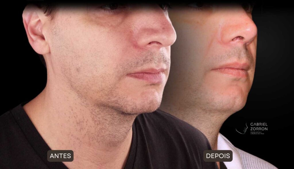 Foto de antes e depois de rinoplastia masculina e natural, realizada pelo especialista Dr Gabriel Zorron - otorrino e cirurgião crânio-maxilo-facial e plástica da face.
