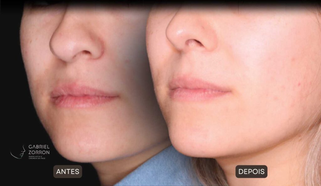 Foto de antes e depois de rinoplastia feminina e natural, realizada pelo especialista Dr Gabriel Zorron - otorrino e cirurgião crânio-maxilo-facial e plástica da face.